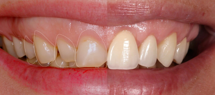 Сколько стоит реставрация (восстановление) эмали зубов